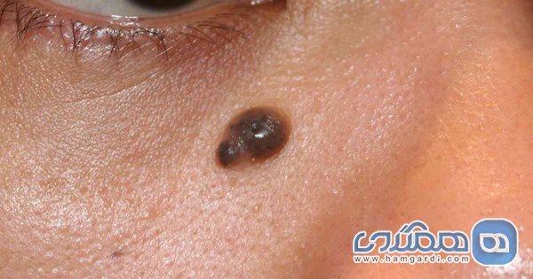 علت خارش خال ، نکاتی مهم در مورد خال ها علت خارش خال ، نکاتی مهم در مورد خال ها
